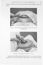 Fig. 49. Cure radicale d'une grosse hernie ombilicale. Incision des téguments / Fig. 50. Id (autre c [...]