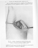Fig. 81. Anatomie chirurgicale de la région de l'anneau crural. Dissection de l'orifice crural montr [...]