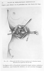 Fig. 118. Découverte du hile du foie par traction sur le rétracteur interne. Dissection des organes  [...]