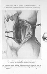 Fig. 467. Id. Découverte du pôle inférieur du rein gauche et dissection de l'uretère jusque dans la  [...]