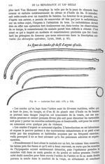 Fig. 41. Ambroise Paré (Edit 1575, p. 310) -  Encyclopédie française d'urologie, publiée sous la dir [...]