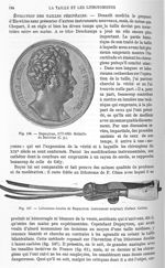 Fig. 106. Dupuytren, 1777-1835 / Fig. 107. Lithotome double de Dupuytren -  Encyclopédie française d [...]