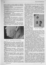 Fig. 263. Blastomycose de la joue (Dr Brocq) / Fig. 264. Gonocoques - Larousse médical illustré ; so [...]