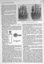 Fig. 1874. Lunette radiochronométrique de Benoist / Fig. 1875. Radiodermites professionnelles (Brocq [...]