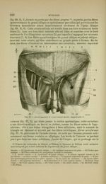 Fig. 67 - Canal inguinal et canal crural ; partie superficielle - Nouveaux éléments d'anatomie descr [...]