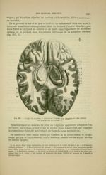 Fig. 190 - Coupe du cerveau, le cervelet et l'isthme sont détachés par une section des pédoncules cé [...]