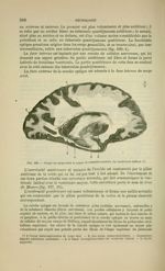 Fig. 193 - Coupe du corps strié et canal circumpédonculaire du ventricule latéral - Nouveaux élément [...]