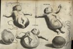 [Foetus d'une forme extraordinaire.] Figures I / Fig. II / Fig. III - Discours anatomiques sur le su [...]