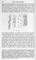 Fig. 19. Tissu conjonctif ondulé - La pathologie cellulaire basée sur l'étude physiologique et patho [...]