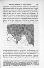 Fig. 129. Ligne de démarcation d'un os nécrosé dans la carie des phalanges - La pathologie cellulair [...]