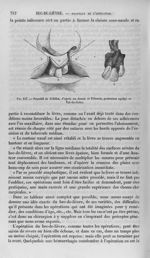 Fig. 117 : Procédé de Sédillot - Nouveau dictionnaire de médecine de chirurgie pratiques, illustré d [...]