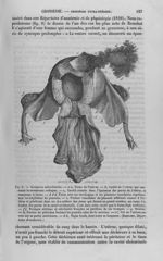 Fig. 8 : Grossesse interstitielle - Nouveau dictionnaire de médecine de chirurgie pratiques, illustr [...]