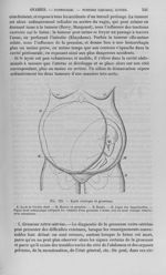 Fig. 125 : Kyste ovarique et grossesse - Nouveau dictionnaire de médecine de chirurgie pratiques, il [...]