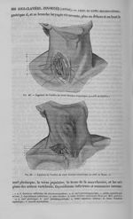 Fig. 49 : Ligature de l'artère du tronc brachio-céphalique procédé de Sédillot. / Fig. 50 : Ligature [...]