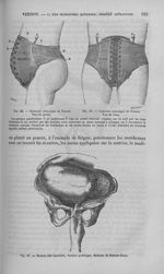 Fig. 35 et 36 : Ceinture eutocique de Pinard. / Fig. 37 : Version dite bipolaire - Nouveau dictionna [...]