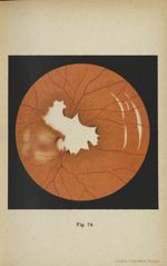 Fig. 74. Traumatisme de l'oeil. Rupture de la choroïde - Atlas manuel d'ophtalmoscopie