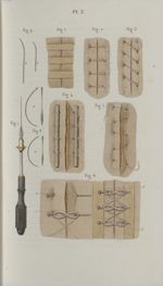 Pl. 2. Réunions. Fig. 2, 3, 4, 5, 6. Sutures - Précis iconographique de médecine opératoire et d'ana [...]