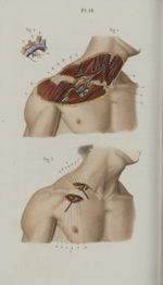 Pl. 10. Ligature des artères axillaire et sous-clavière - Précis iconographique de médecine opératoi [...]