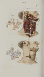Pl. 11. Ligature des artères carotide primitive, linguale et faciale - Précis iconographique de méde [...]