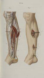 Pl. 14. Ligature de l'artère tibiale postérieure - Précis iconographique de médecine opératoire et d [...]