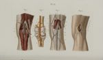 Pl. 15. Ligature de l'artère poplitée - Précis iconographique de médecine opératoire et d'anatomie c [...]