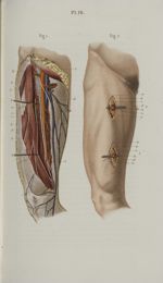 Pl. 16. Ligature de l'artère fémorale - Précis iconographique de médecine opératoire et d'anatomie c [...]