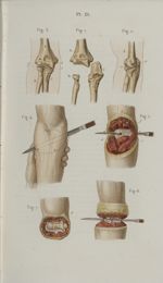 Pl. 21. Désarticulation du coude - Précis iconographique de médecine opératoire et d'anatomie chirur [...]