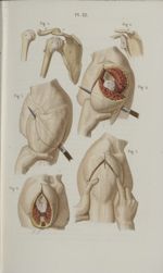 Pl. 22. Désarticulation de l'épaule - Précis iconographique de médecine opératoire et d'anatomie chi [...]