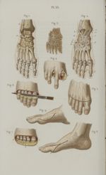 Pl. 23. Désarticulation des orteils - Précis iconographique de médecine opératoire et d'anatomie chi [...]