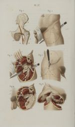 Pl. 27. Désarticulation de la cuisse - Précis iconographique de médecine opératoire et d'anatomie ch [...]