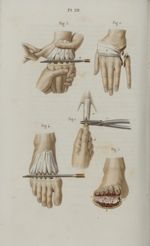 Pl. 28. Amputations qui se pratiquent sur le pied et sur la main - Précis iconographique de médecine [...]