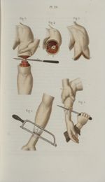 Pl. 29. Amputations de l'avant-bras et du bras - Précis iconographique de médecine opératoire et d'a [...]