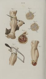 Pl. 30. Amputation de la jambe - Précis iconographique de médecine opératoire et d'anatomie chirurgi [...]