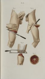Pl. 31. Amputation de la cuisse - Précis iconographique de médecine opératoire et d'anatomie chirurg [...]