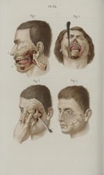 Pl. 34. Résection du maxillaire inférieur et du maxillaire supérieur - Précis iconographique de méde [...]