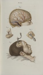 Pl. 35. Trépanation des os du crâne - Précis iconographique de médecine opératoire et d'anatomie chi [...]
