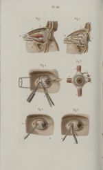 Pl. 40. Opérations qui se pratiquent sur les muscles de l'œil - Précis iconographique de médecine op [...]