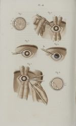 Pl. 41. Opération de la cataracte par abaissement - Précis iconographique de médecine opératoire et  [...]