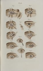 Pl. 42. Cataracte et pupille artificielle - Précis iconographique de médecine opératoire et d'anatom [...]