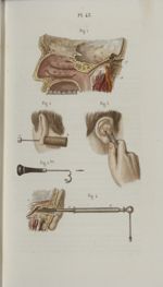 Pl. 43. Opérations qui se pratiquent sur l'oreille - Précis iconographique de médecine opératoire et [...]