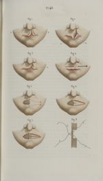 Pl. 45. Suite du bec de lièvre, etc. - Précis iconographique de médecine opératoire et d'anatomie ch [...]
