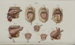 Pl. 48. Cancer de la langue et opération de bégayement - Précis iconographique de médecine opératoir [...]