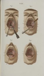 Pl. 50. Staphyloraphie - Précis iconographique de médecine opératoire et d'anatomie chirurgicale / p [...]