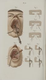 Pl. 51. Staphyloraphie - Précis iconographique de médecine opératoire et d'anatomie chirurgicale / p [...]