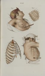 Pl. 57. Extirpation du sein. - Empyème - Précis iconographique de médecine opératoire et d'anatomie  [...]