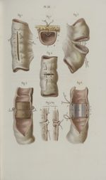 Pl. 59. Plaies des intestins - Précis iconographique de médecine opératoire et d'anatomie chirurgica [...]