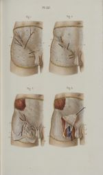 Pl. 60. Hernies. Anatomie chirurgicale de la région inguinale - Précis iconographique de médecine op [...]