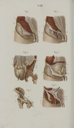 Pl. 61. Suite de l'anatomie chirurgicale de la région inguinale - Précis iconographique de médecine  [...]