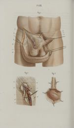 Pl. 62. Anatomie chirurgicale du scrotum et du cordon testiculaire - Précis iconographique de médeci [...]
