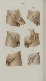Pl. 65. Cure radicale des hernies - Précis iconographique de médecine opératoire et d'anatomie chiru [...]